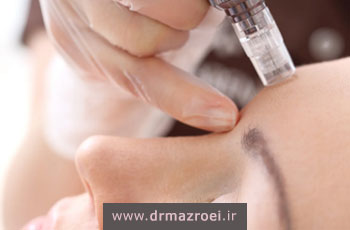 میکرونیدلینگ صورت چیست و چه کاربردی دارد؟