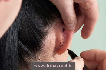 مراقبت های مهم بعد از جراحی زیبایی گوش (اتوپلاستی)