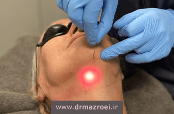 اندولیفت صورت چیست؟ مزایا، هزینه، ماندگاری، عوارض + فیلم و عکس قبل و بعد