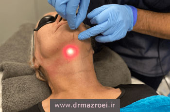 اندولیفت غبغب چیست؟ هزینه، مزایا، ماندگاری + عکس قبل و بعد