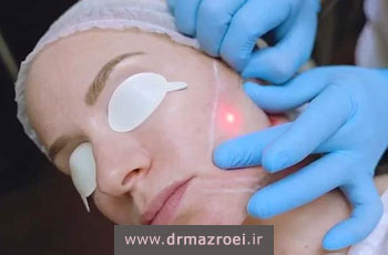 اندولیفت برای جای جوش چیست؟ بررسی نتایج، ماندگاری و فیلم درمان