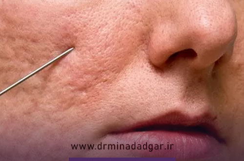 عوارض سابسیژن چیست؟ بررسی کامل عوارض بعد از سابسیژن
