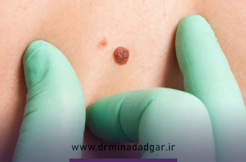 خالبرداری با دستگاه RF؛ روشی ایمن و دقیق برای حذف خال