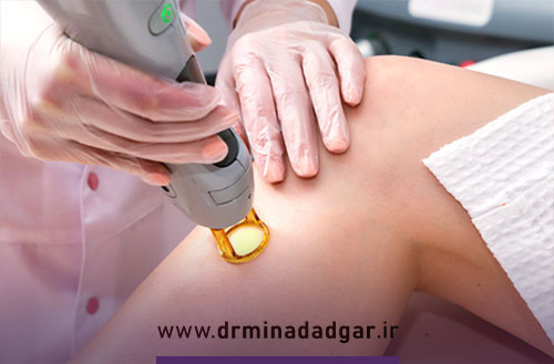 تعداد جلسات لیزر موهای زائد و فاصله بین هر جلسه چقدر است؟