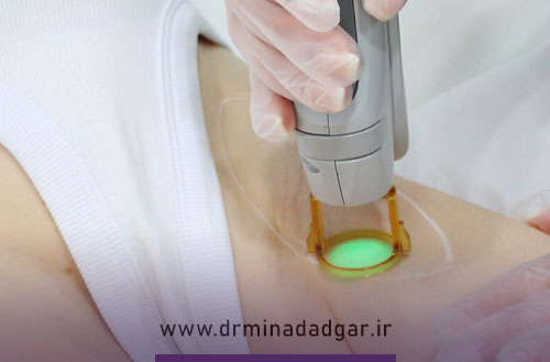 سن مناسب لیزر موهای زائد؛ از چند سالگی می توان لیزر کرد؟