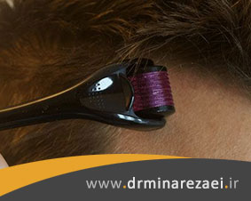 نحوه استفاده از درمارولر برای درمان ریزش مو