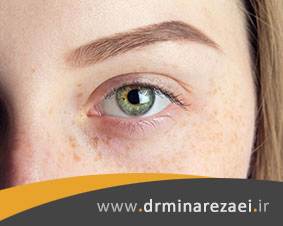 علائم کک و مک صورت چیست و روشهای درمان آن کدام است؟
