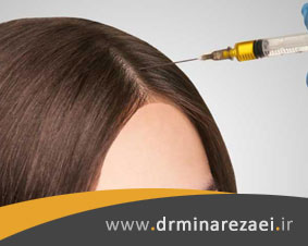 درمان ریزش مو با پی آر پی
