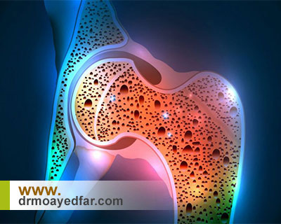 علت پوکی استخوان و راههای پیشگیری از آن