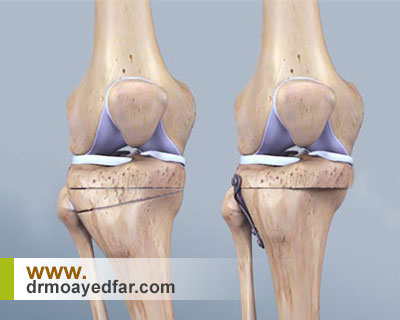 استئوتومی چیست؟
