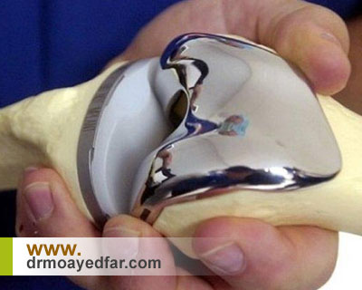 مراحل انجام جراحی تعویض کامل مفصل زانو