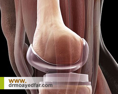 آیا برای انجام جراحی زانو سن خاصی مناسب است؟