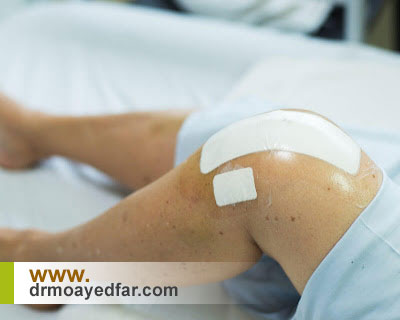 دوره نقاهت پس از عمل تعویض مفصل زانو چه مدت است؟