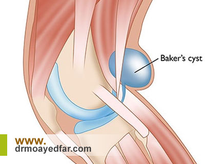آیا کیست بیکر خطرناک است؟