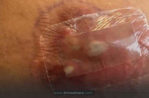با عوارض خطرناک تزریق چربی آشنا شوید؛ از کبودی تا نکروز چربی