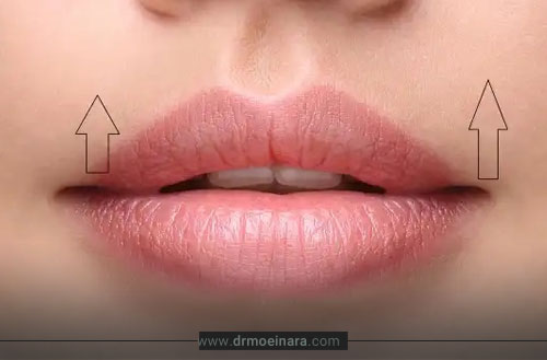 جراحی لیفت سانترال لب؛ روش، مزایا و نتایج آن