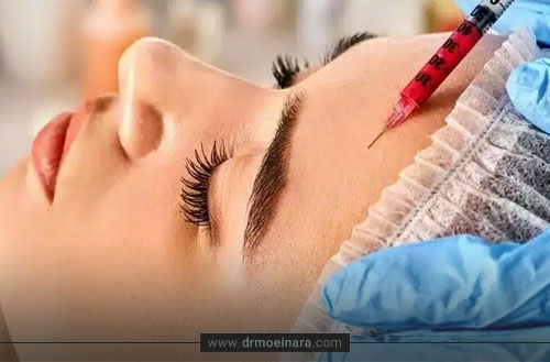 همه چیز درباره بوتاکس پیشانی؛ مزایا، ماندگاری و مراقبت ها