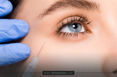 تزریق فیلر زیر چشم؛ مزایا، نحوه تزریق، مراقبتها و هزینه
