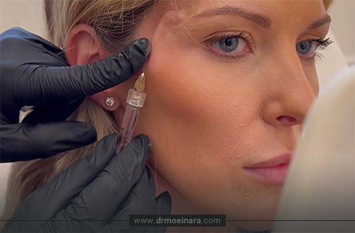 فیلر شقیقه؛ نحوه تزریق، ماندگاری و قیمت فیلر شقیقه