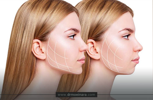 بوکال فت چیست؟ انواع، نحوه انجام و هزینه عمل بوکال فت ۱۴۰۴