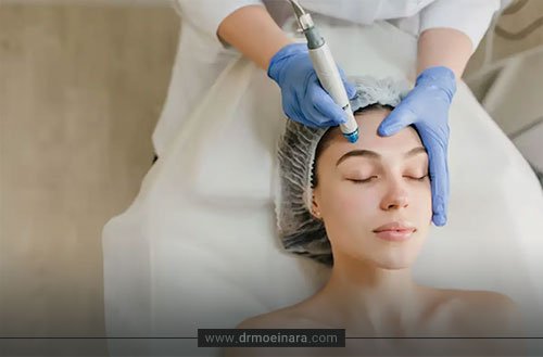 مزوتراپی صورت؛ همه چیز درباره جوانسازی و رفع لک پوست
