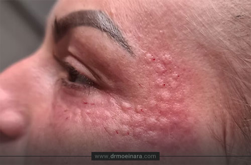عوارض مزوتراپی مو، صورت و بدن + راه های کاهش عوارض مزوتراپی