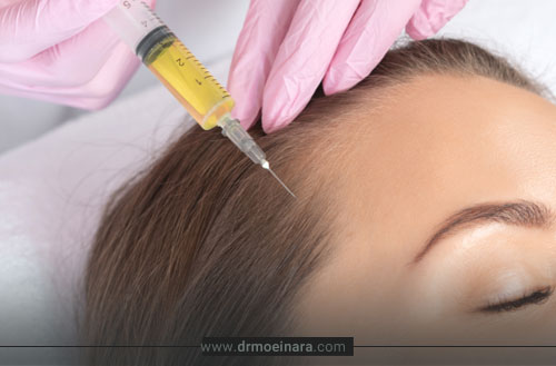 پی آر پی مو چیست و چگونه باعث تقویت و رشد مجدد مو می شود؟