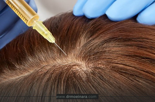 عوارض پی آر پی مو؛ بررسی کامل عوارض کوتاه مدت و بلندمدت PRP مو