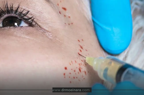 پی آر اف صورت (PRF)؛ فواید، ماندگاری + مراقبت های بعد از پی آر اف صورت