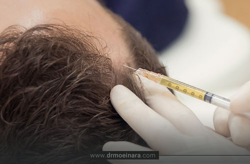 پی آر اف مو؛ فواید، عوارض، هزینه + مراقبت های بعد از تزریق PRF مو