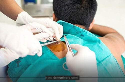 برداشتن ضایعات پوستی؛ روش ها، درمان و رفع ضایعات پوستی صورت و بدن