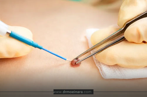 برداشتن خال؛ روش ها، مراقبت ها + هزینه برداشتن خال 1404