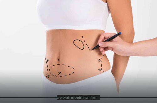 تفاوت ابدو و مینی ابدو؛ فرق ابدومینوپلاستی با مینی ابدو در چیست؟