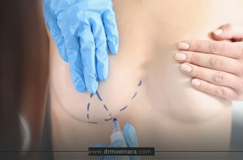 راهنمای انتخاب بهترین جراح ماموپلاستی در تهران؛ معیارهایی که باید بدانید