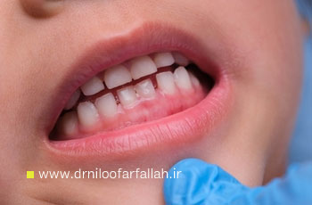 عفونت لثه کودکان؛ راهنمای والدین برای کنترل التهاب و درد