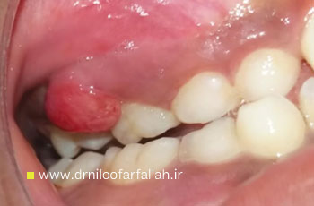 گرانولوم پیوژنیک در کودکان چیست و چگونه درمان می شود؟