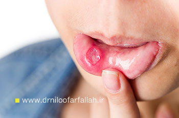 تفاوت آفت با سرطان دهان؛ علائم اولیه را اشتباه نگیرید