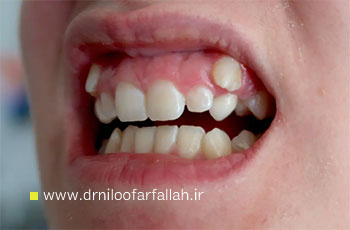 اکتوپیک اراپشن (رویش نابجای دندان)؛ علل، تشخیص و درمان