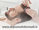 مزوتراپی مو روشی موثر برای درمان ریزش مو