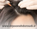 تزریق هیر فیلر؛ نظرات در مورد هیر فیلر مو + قیمت هیر فیلر 1404