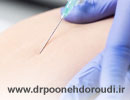 تزریق مزو چربی سوز؛ روش انجام، مزایا، عوارض + قیمت مزوتراپی چربی سوز 1404