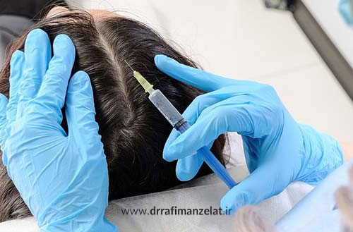 پی آر جی اف مو؛ خداحافظی با ریزش و کم پشتی موهایتان با (PRGF)