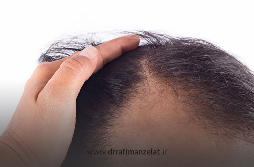 ریزش مو ناشی از فولیکولیت؛ آیا کاشت مو راه حل قطعی است؟