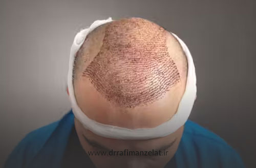 بهترین سن برای کاشت مو؛ چه سنی برای کاشت مو مناسب تر است؟