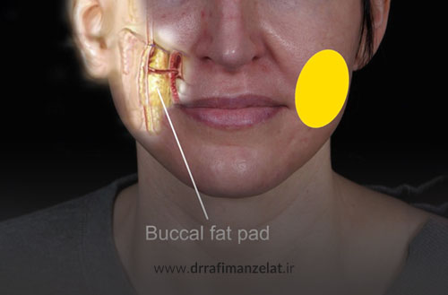 عوارض جراحی بوکال فت؛ بررسی کامل خطرات تخلیه چربی گونه