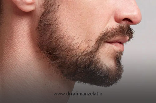 کاشت ریش و سبیل؛ راهی طبیعی برای داشتن ریش پرپشت