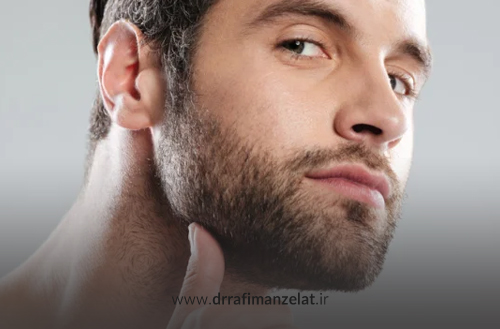 عوارض احتمالی کاشت ریش و سبیل که قبل از عمل باید بدانید