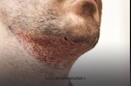 مراقبت های بعد از کاشت ریش و سبیل؛ از شستشو تا اصلاح و تغذیه مناسب