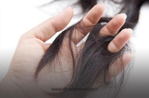 ریزش مو؛ بررسی کامل دلایل، انواع و علائم آن