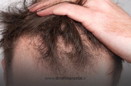 ریزش مو بر اثر مصرف دارو؛ چگونه ریزش موی دارویی را درمان کنیم؟